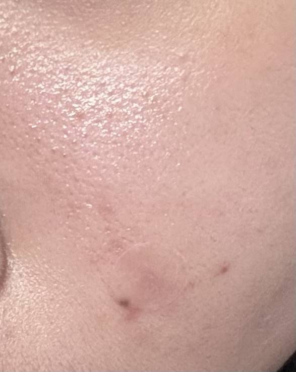 [잡담] 그래도 피부 마니 좋아졌다...ㅠ | 인스티즈