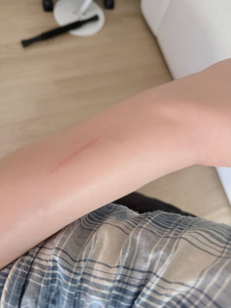 [잡담] 만두굽던 후라이팬에 진짜 잠깐 스쳤는데 데인건가 흑 ㅜ | 인스티즈