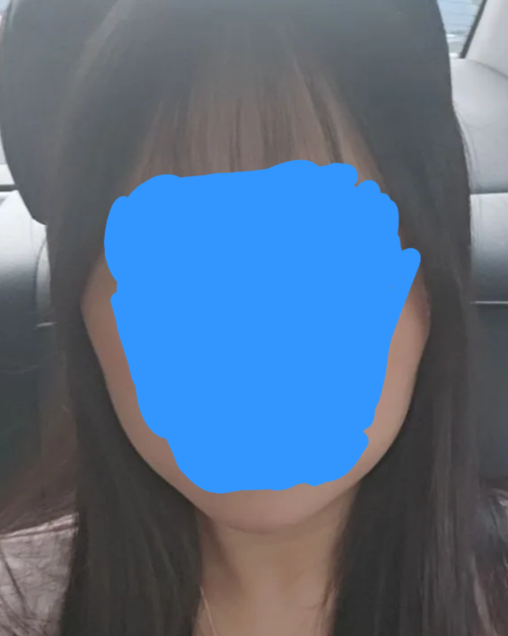 [잡담] 내 얼굴형 사각턱 보톡스 맞으면 볼패임 심할까? | 인스티즈
