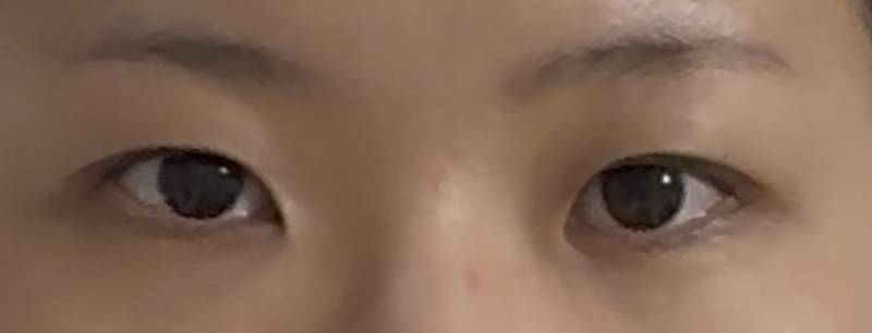 [잡담] 이런 눈이면 앞트임 할 거임? | 인스티즈