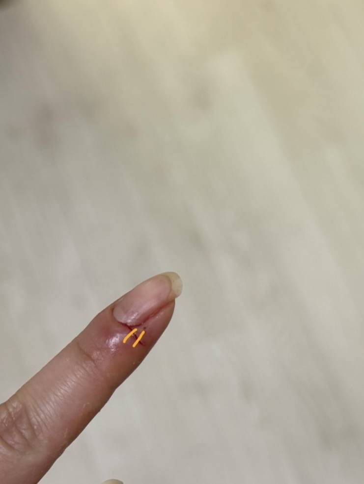 [잡담] 양파 썰다가 손가락 썰었는데 주방에 기절해있다가 깸 | 인스티즈