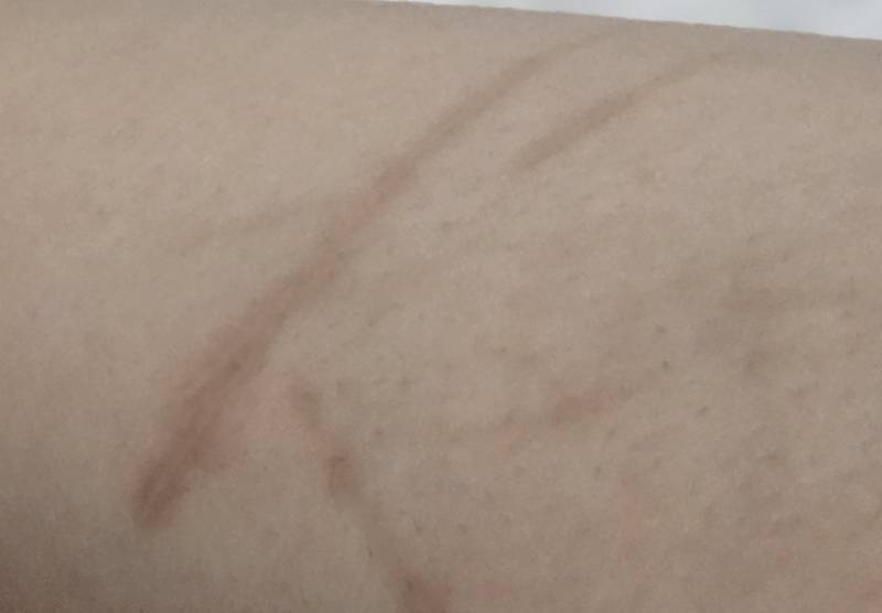 [잡담] 이런 상처 빨리 없앨수 있는 연고 있을까?? | 인스티즈