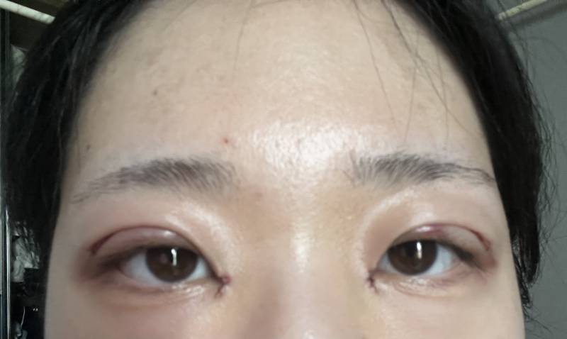 [잡담] 나 절개 쌍수했는데 이거 나중에 속쌍될거같아 ? 이틀차야 ㅎㅇㅈㅇ | 인스티즈