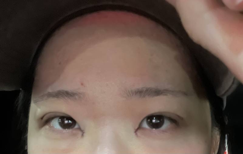 [잡담] 나 절개 쌍수했는데 이거 나중에 속쌍될거같아 ? 이틀차야 ㅎㅇㅈㅇ | 인스티즈