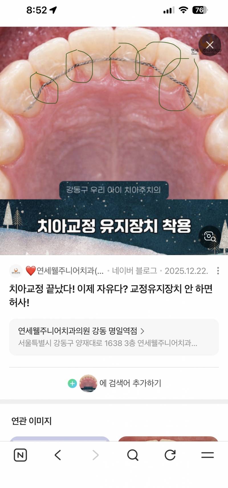 [잡담] 유지장치 치아뒤에 붙이는거 | 인스티즈