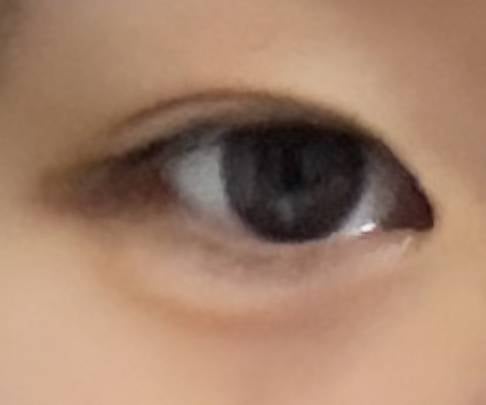 [잡담] 난 뒤밑트 수술한거 개후회함 | 인스티즈