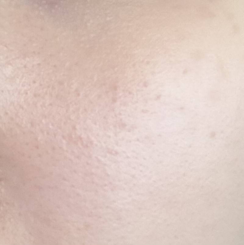 [잡담] 피부과 갔다와도 또 나고 또 나고 미쳐버려ㅠㅠ ㅎㅇㅈㅇ… | 인스티즈