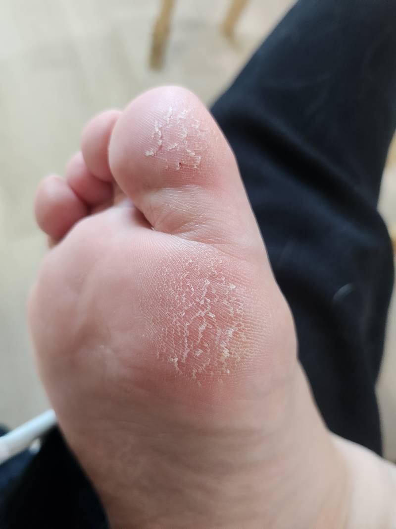 [잡담] 로션 바르면 괜찮아질라나 | 인스티즈