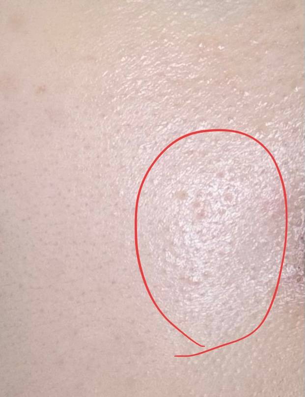 [잡담] 얘들아 이거 편평사마귀야? ㅎㅇㅈㅇ… | 인스티즈