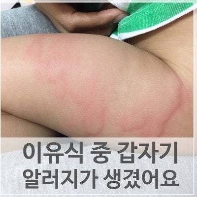 [잡담] 피부가 하루에도 몇번씩 모기 물린 것처럼 부어오르는데 | 인스티즈