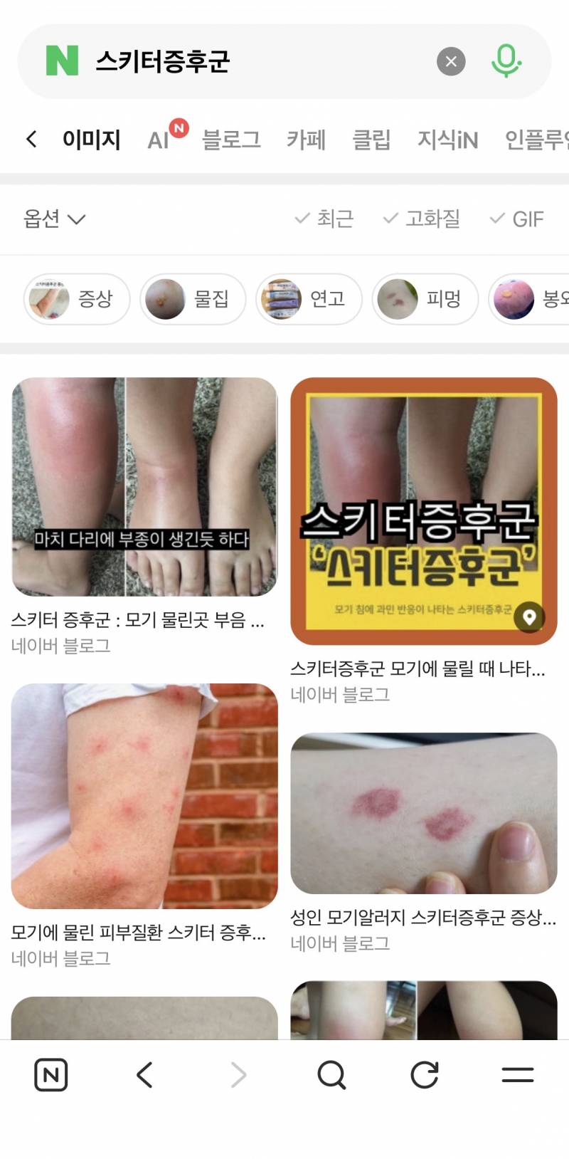 [잡담] 스키터 증후군 있는 사람 ㅠㅠ | 인스티즈
