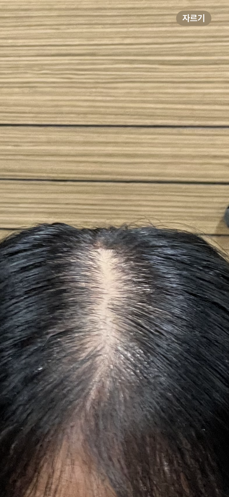 [잡담] 여성탈모맞지?? | 인스티즈