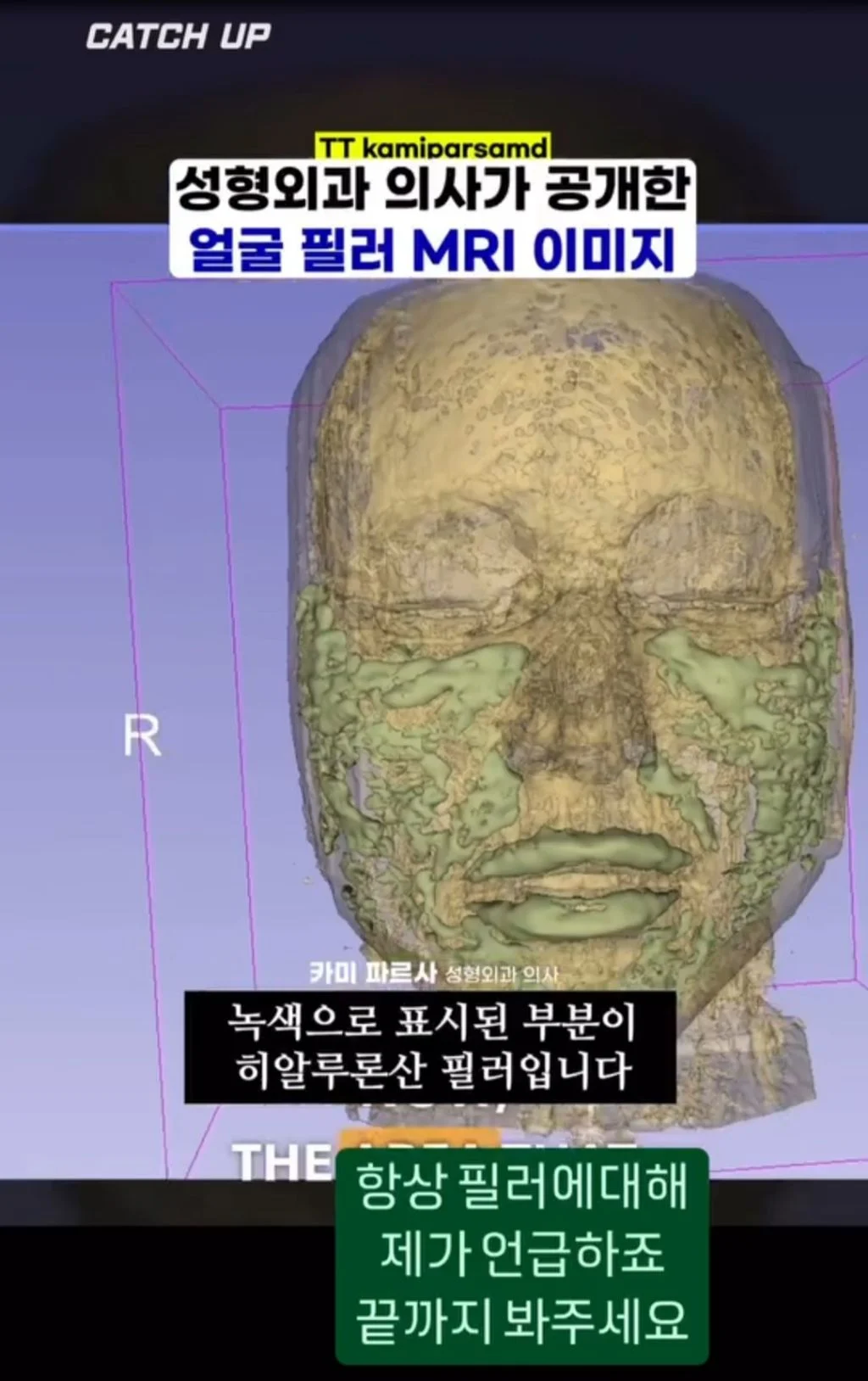 [잡담] 예전에는 필러는 녹으니 괜찮다고 했었어? | 인스티즈