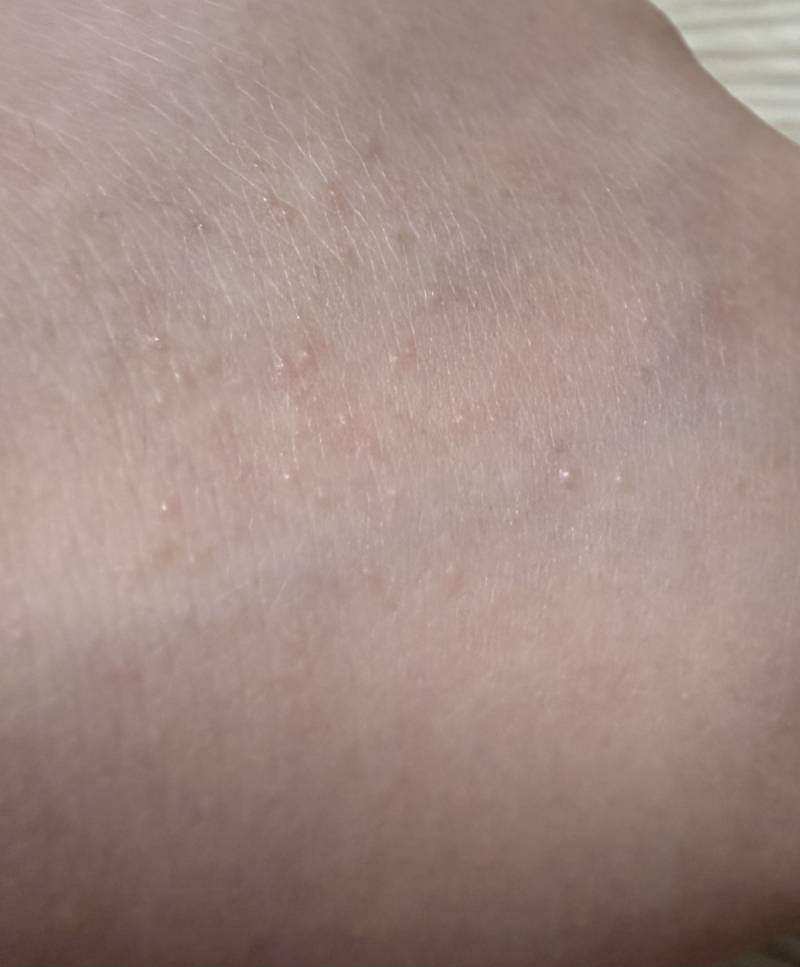 [잡담] 몸에 이런 오돌토돌한게 났어 ㅠㅠㅠㅠㅠㅠ 뭐야? | 인스티즈