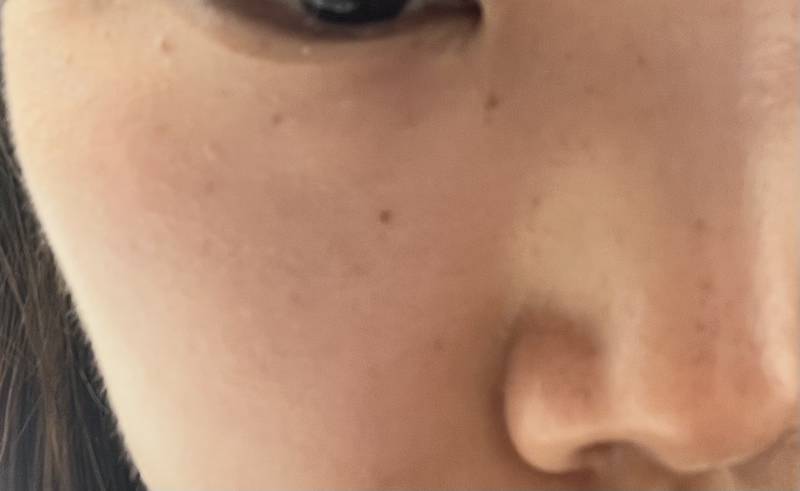 [잡담] 여행가기전에 비립종+편사+점제거 할까? | 인스티즈