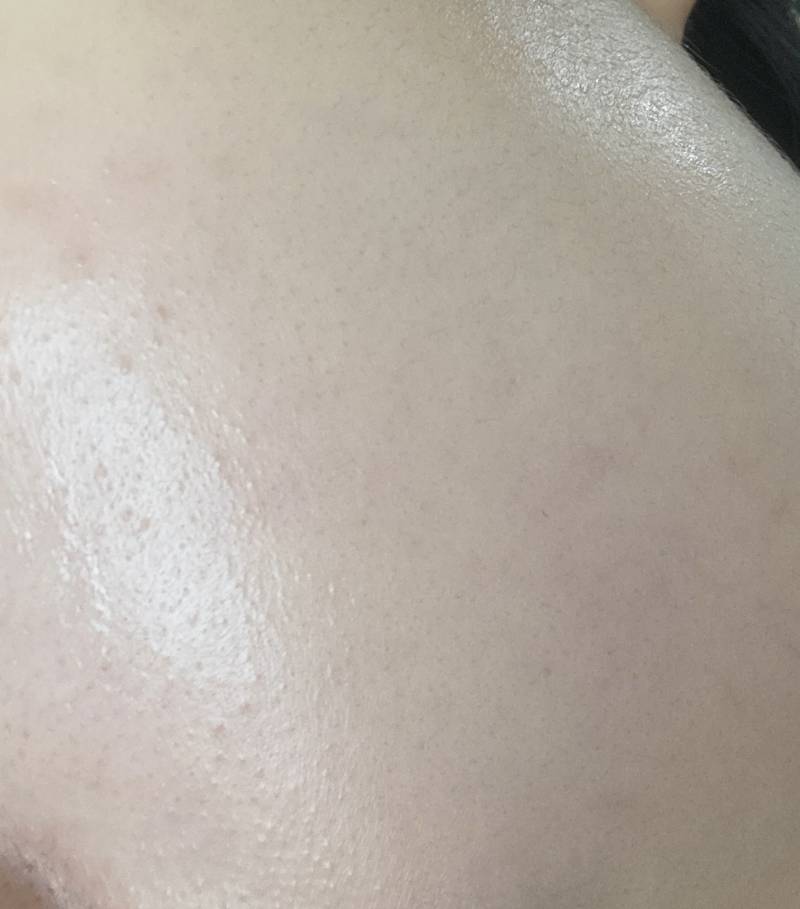 [잡담] 피부 오돌토돌 간지러워..ㅜㅜ 뭐같아? ㅎㅇㅈㅇ.. | 인스티즈