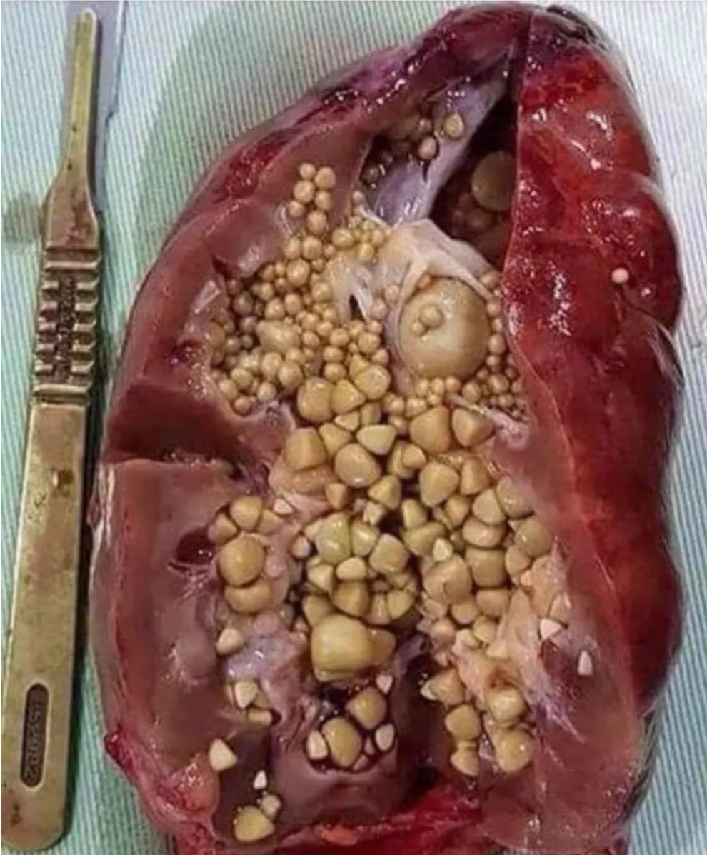 [잡담] (혐오주의)에너지드링크 마셔서 망가진 콩팥 실물 | 인스티즈