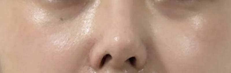 [잡담] 양악하고 코 변형됐는데..하 | 인스티즈