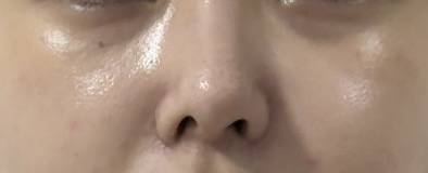 [잡담] 양악하고 코 변형됐는데..하 | 인스티즈