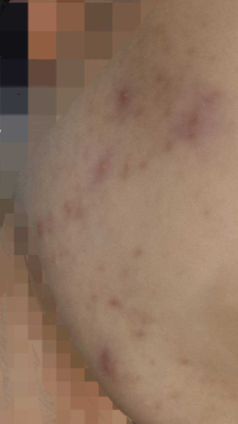 [잡담] 여드름 너무 심하게 났는데 어떡해? 사진주의.. 도와줘ㅜㅜㅜ | 인스티즈