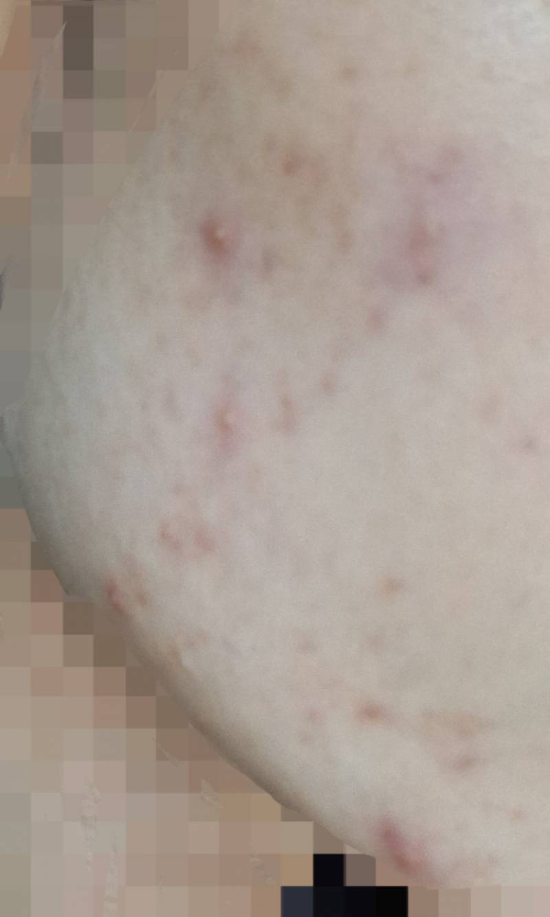 [잡담] 여드름 너무 심하게 났는데 어떡해? 사진주의.. 도와줘ㅜㅜㅜ | 인스티즈