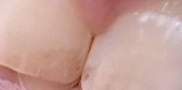 [잡담] 익들아 나 앞니 색깔이 이런데..충친가..? 사진있음.. | 인스티즈