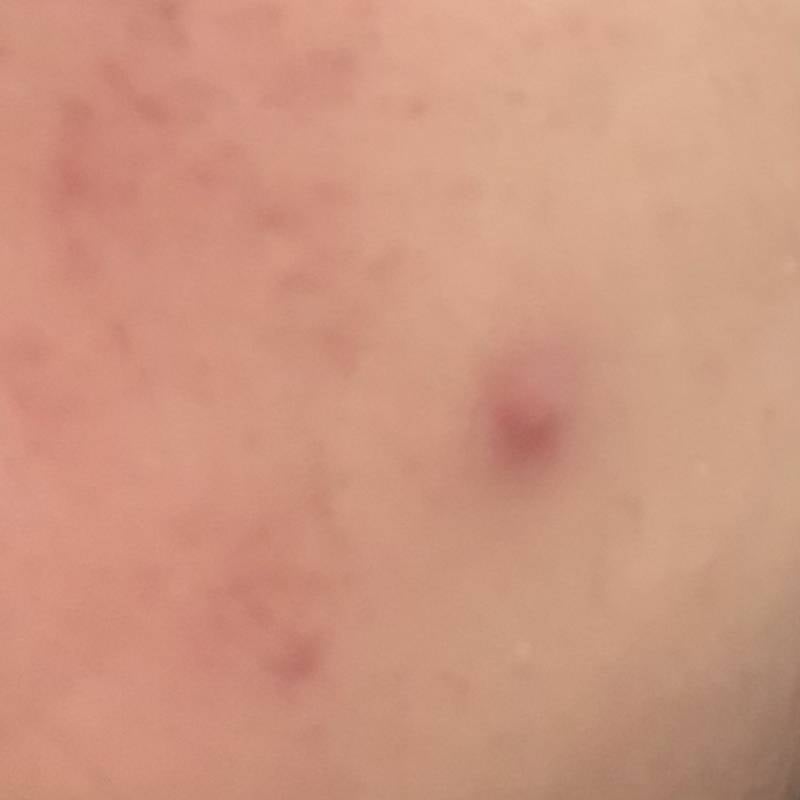 [잡담] 얘들아 이게 화농성 여드름이야???ㅠㅠㅠ | 인스티즈