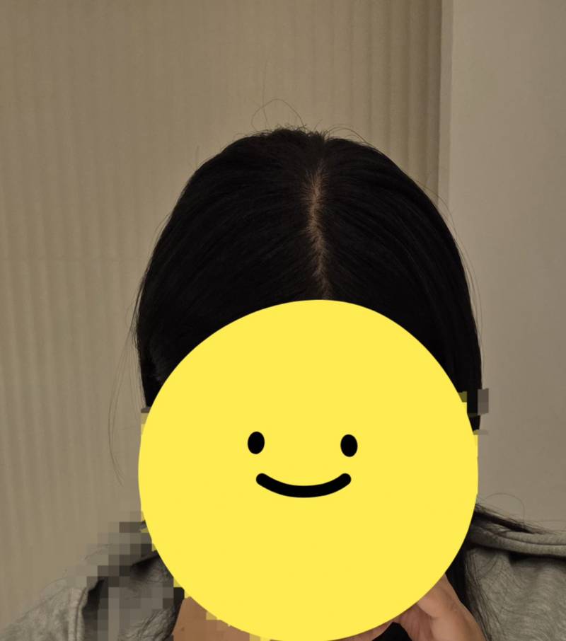 [잡담] 나 탈모일까..? | 인스티즈