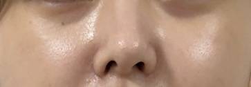 [잡담] 양악 후에 코 변형온거 좀 나아진거같음 | 인스티즈