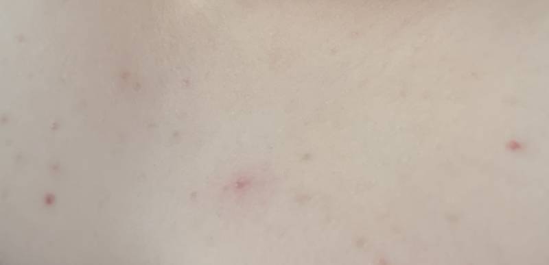 [잡담] 가드름 겁나 심한데 걍 피부과 가?? ㅠㅠㅠㅠ 이거 뭐 약 발라도 똑같지?? ㅎㅇㅈㅇ | 인스티즈