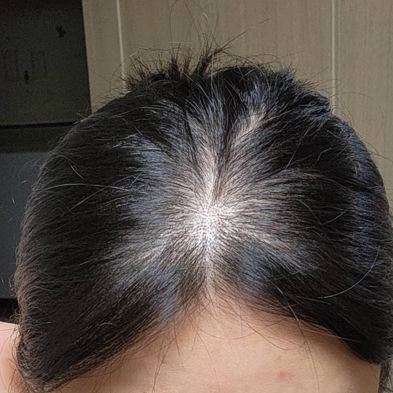 [잡담] 탈모 많이 좋아진 것 같아? | 인스티즈