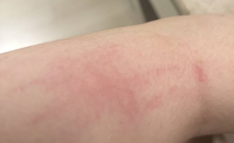 [잡담] 요즘 몸에 모기물린처럼 뭐가 나는데 간지러워ㅠㅠㅠ | 인스티즈