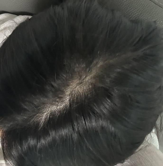 [잡담] 내 정수리… 탈모 위험군일까?? | 인스티즈