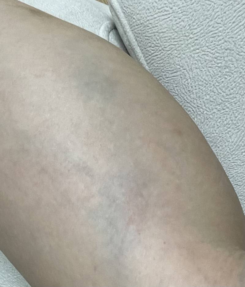 [잡담] 다리에 멍 이거 내일 되면 더 심해지려나?? | 인스티즈