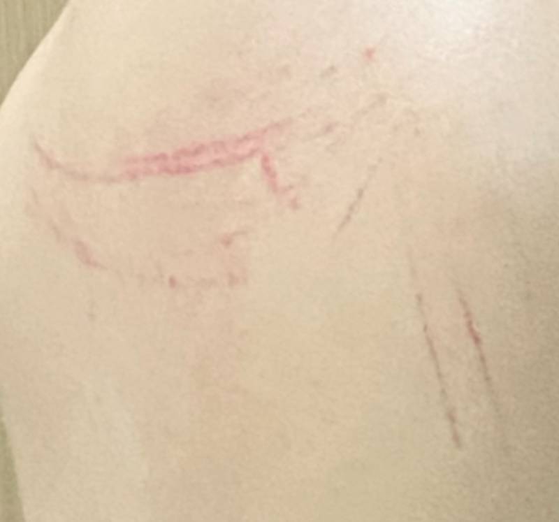 [잡담] 바디브러쉬 쓰다가 등에 상처 개ㅐㅐㅐ크게 남 어떡해…????? | 인스티즈