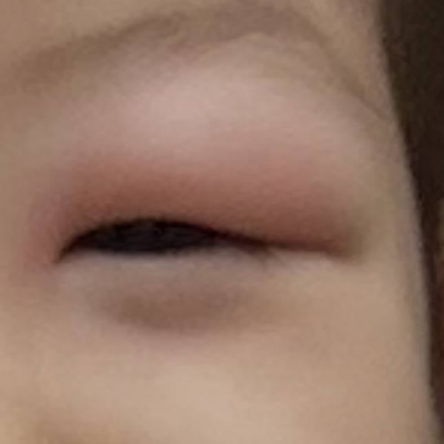 [잡담] 우리딸 모기 물렸는데 | 인스티즈