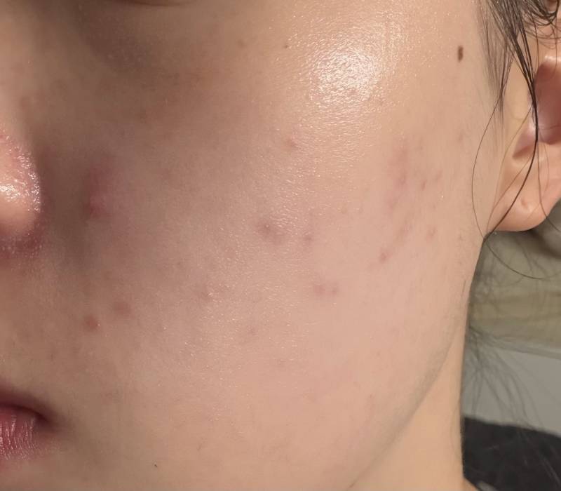 [잡담] 나 진짜 피부 뒤집어진거땜에 죽고싶다… | 인스티즈