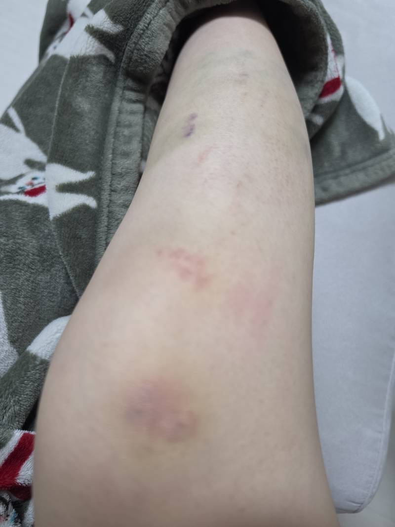 [잡담] 다리에 멍 대박적으로 생김ㅜ | 인스티즈