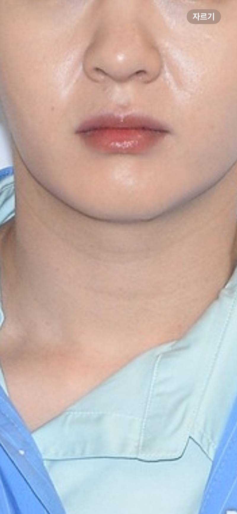 [잡담] 97년생인데 얼굴에 이런거잇으면 심한거야?? | 인스티즈