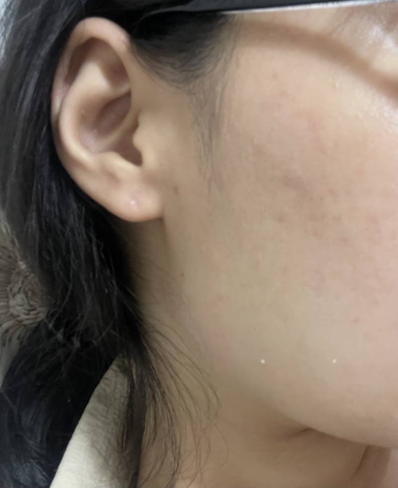 [잡담] 이런 피부는 시술 뭐 해야해? | 인스티즈