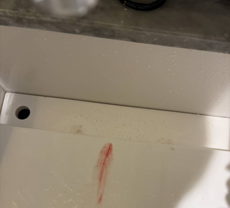 [잡담] 아니 나 각혈? 하는데 이거 병원 가봐야하지(가래사진잇음) | 인스티즈