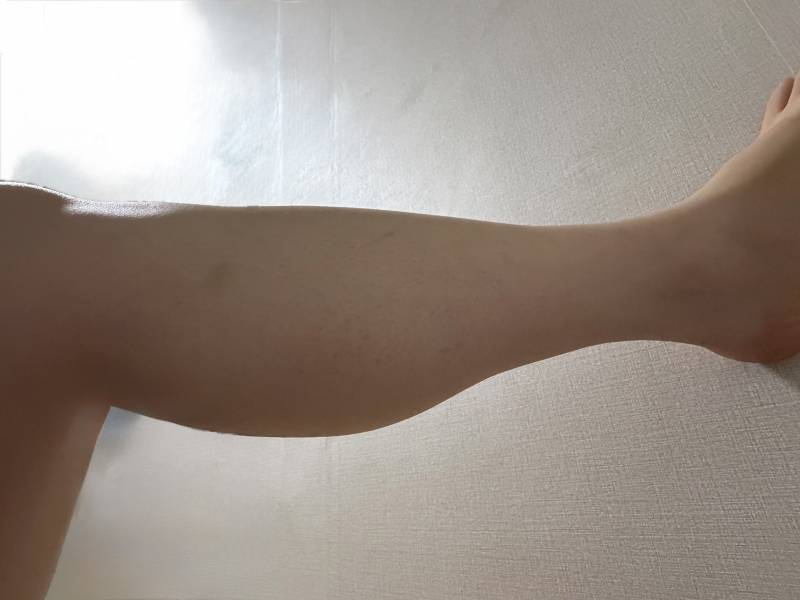 [잡담] 나 종아리알 개심한데 이거 어케해결해… | 인스티즈
