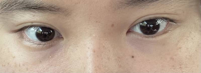 [잡담] 나 쌍수 할까? | 인스티즈