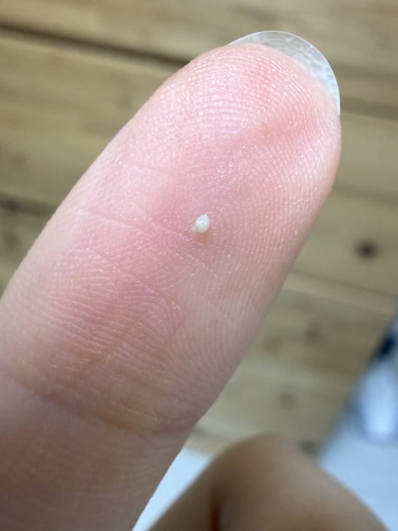 [잡담] 와쒸 6개월 박혀있던 비립종 빼냈다... ㅇㅎㅈㅇ | 인스티즈