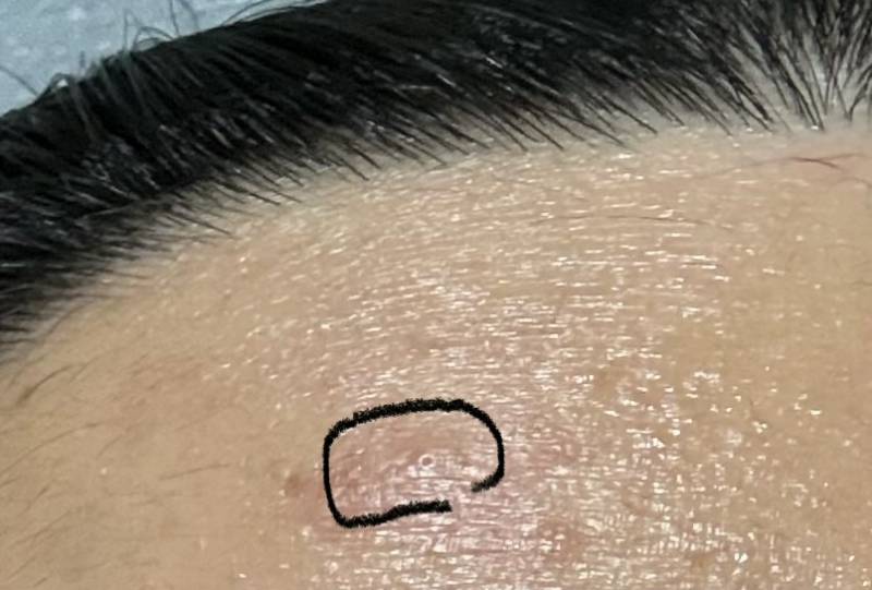 [잡담] 이런거 피부과가면 짜주나? | 인스티즈