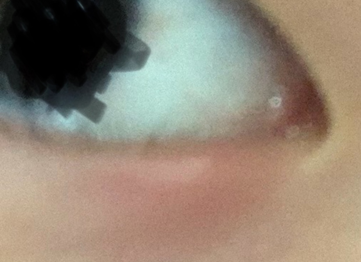 [잡담] 애교살 빨갛게 부은거 모지 | 인스티즈