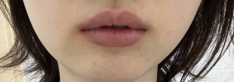 [잡담] 나 입술필러 하는게 낫겠지? | 인스티즈