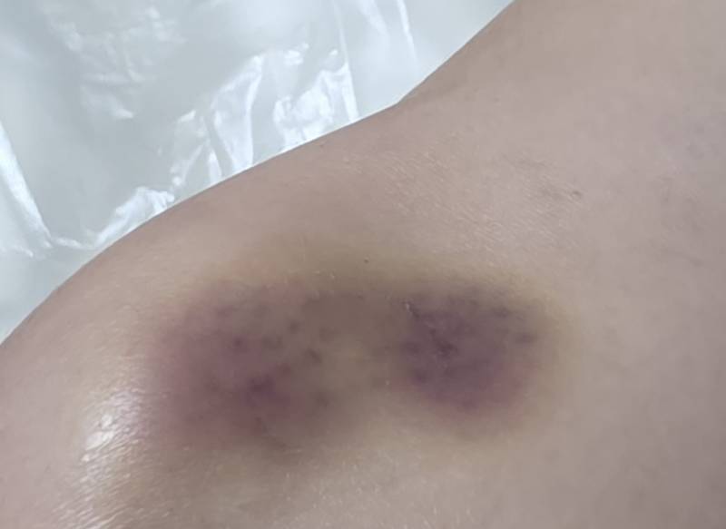 [잡담] 무릎 주사 맞은 곳 멍이 넘 크게 들었어,,, | 인스티즈