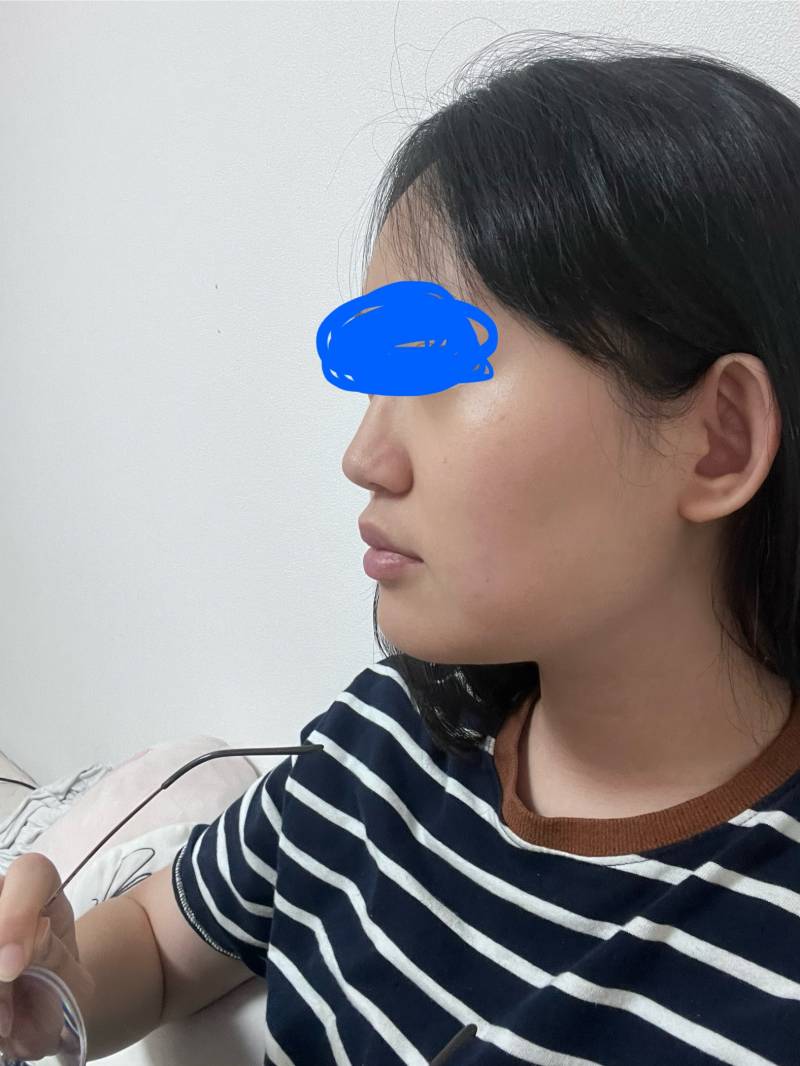 [잡담] 시술 추천해줄 수 있어? | 인스티즈