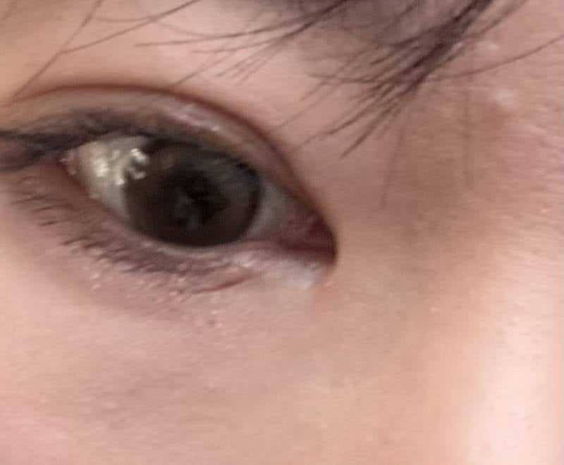 [잡담] 앞트임한 부위가 빨갛게 됐눈데 왜이래?? | 인스티즈
